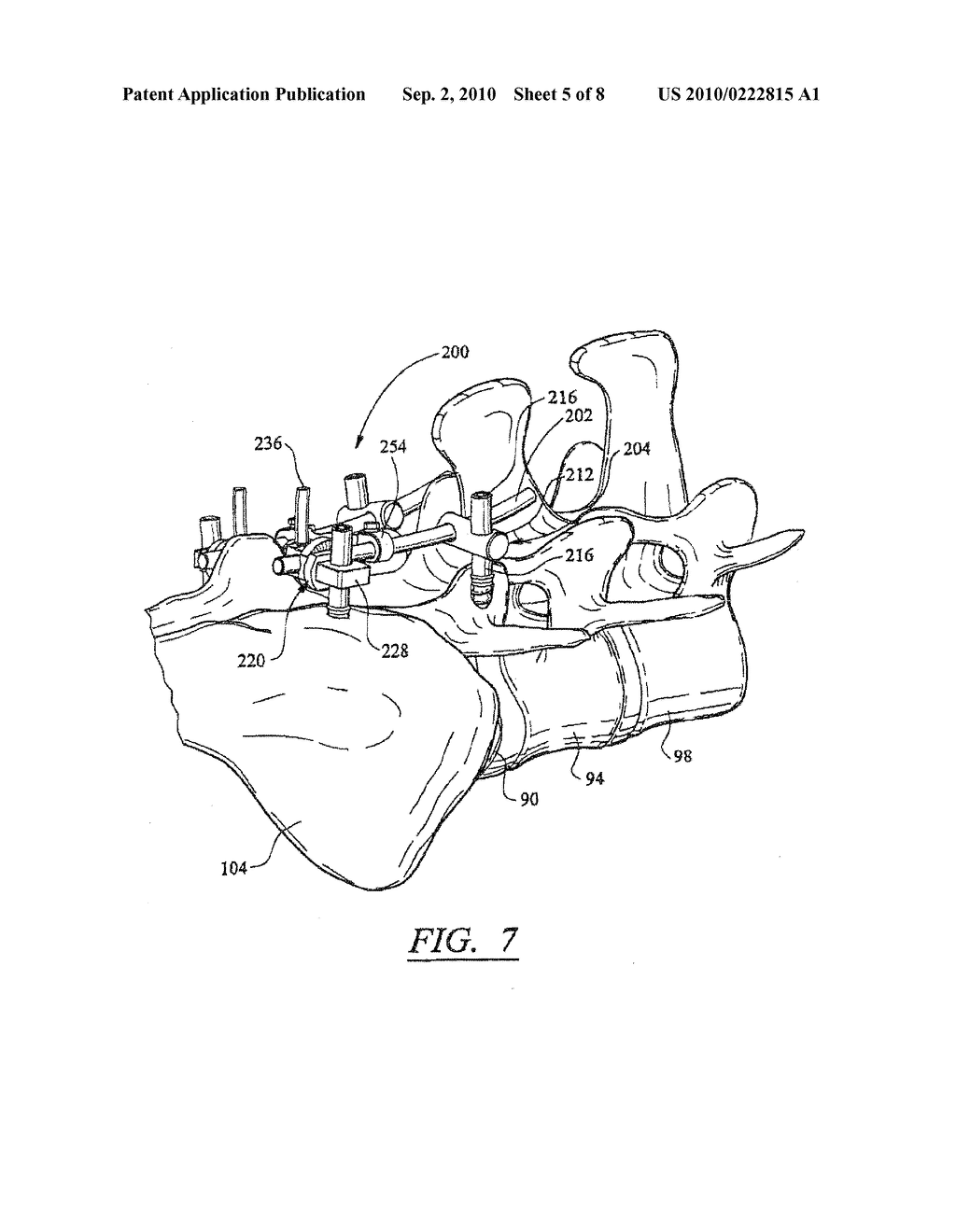 ARTIFICIAL FACET JOINT AND METHOD - diagram, schematic, and image 06