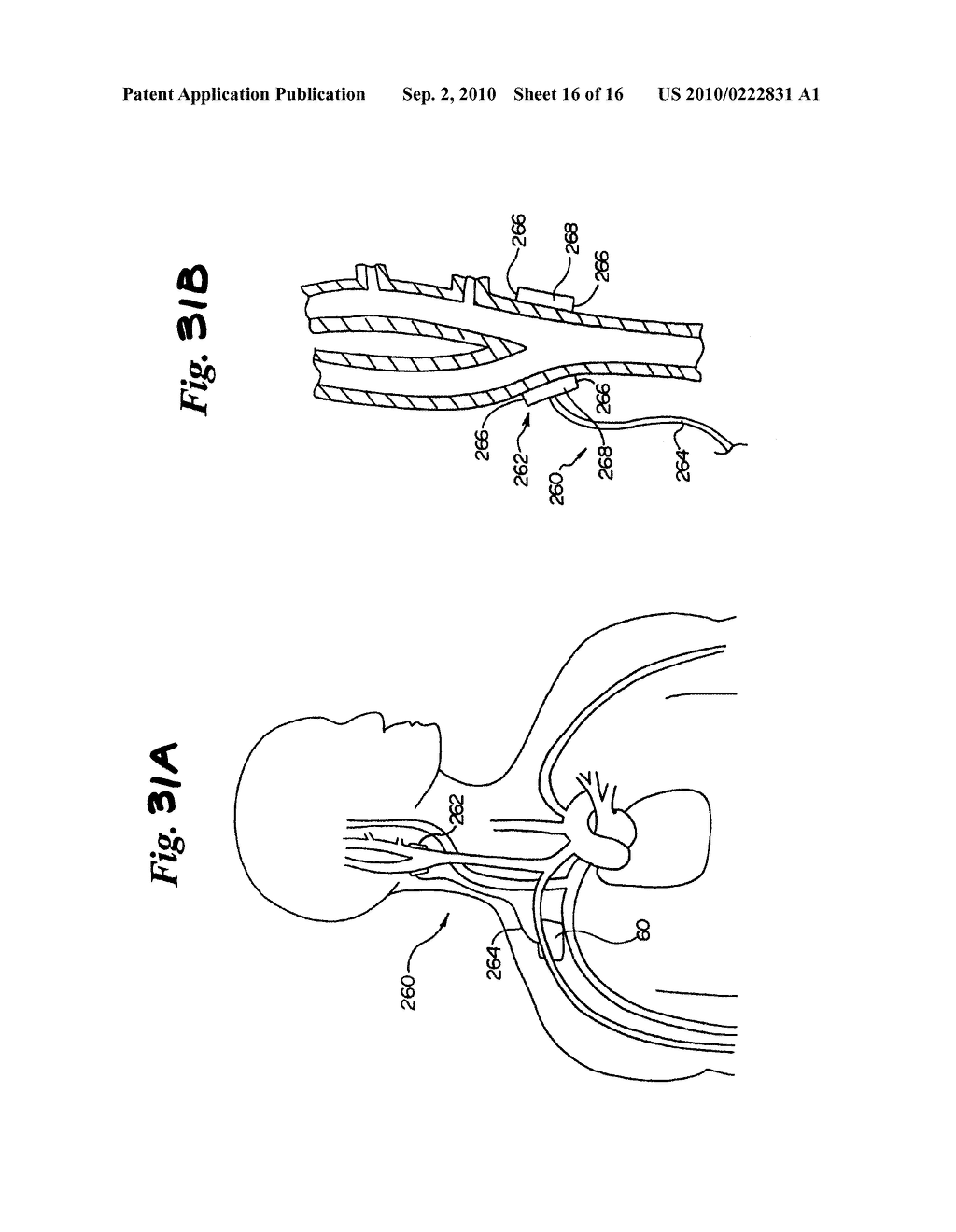 ELECTRODE STRUCTURES AND METHODS FOR THEIR USE IN CARDIOVASCULAR REFLEX CONTROL - diagram, schematic, and image 17