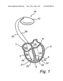 IMPLANTABLE CARDIAC STIMULATOR, DEVICE AND METHOD FOR MONITORING THE HEART CYCLE IN A HUMAN HEART diagram and image