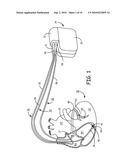 SYSTEM AND METHOD FOR CONDITIONAL BIVENTRICULAR PACING diagram and image