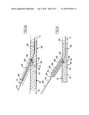 System for Treating Lesions on a Blood Vessel Bifurcation diagram and image