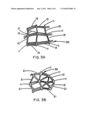 Intraluminal Stent Graft diagram and image