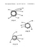 Intraluminal Stent Graft diagram and image