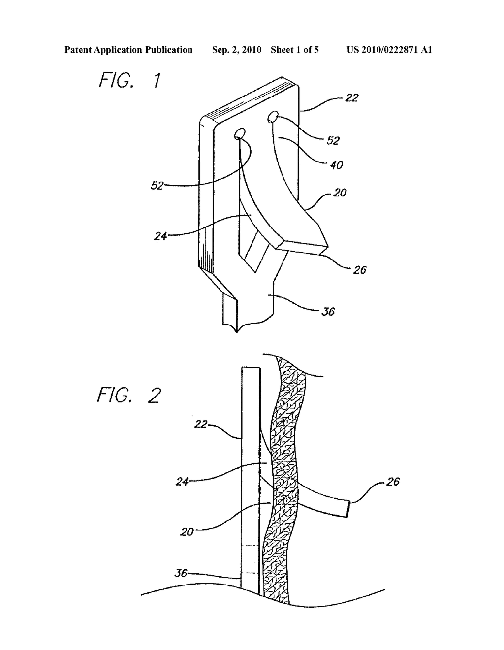 MECHANISM FOR SECURING TO A CORPOREAL LUMEN AND METHOD OF MANUFACTURING - diagram, schematic, and image 02