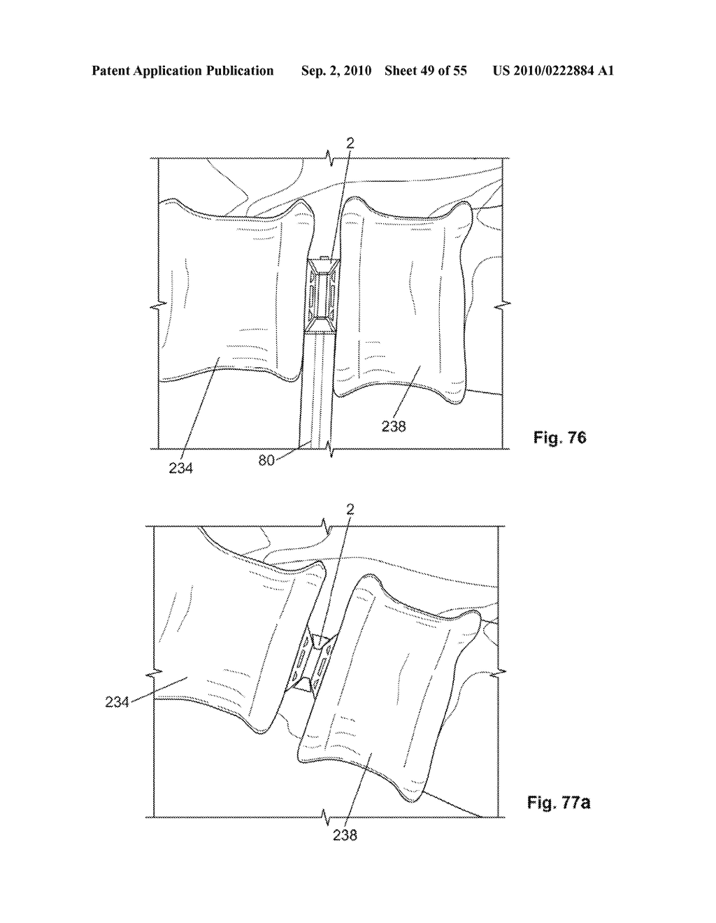 FIXATION DEVICE AND METHOD - diagram, schematic, and image 50