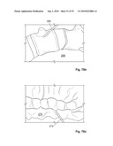 FIXATION DEVICE AND METHOD diagram and image