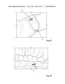 FIXATION DEVICE AND METHOD diagram and image