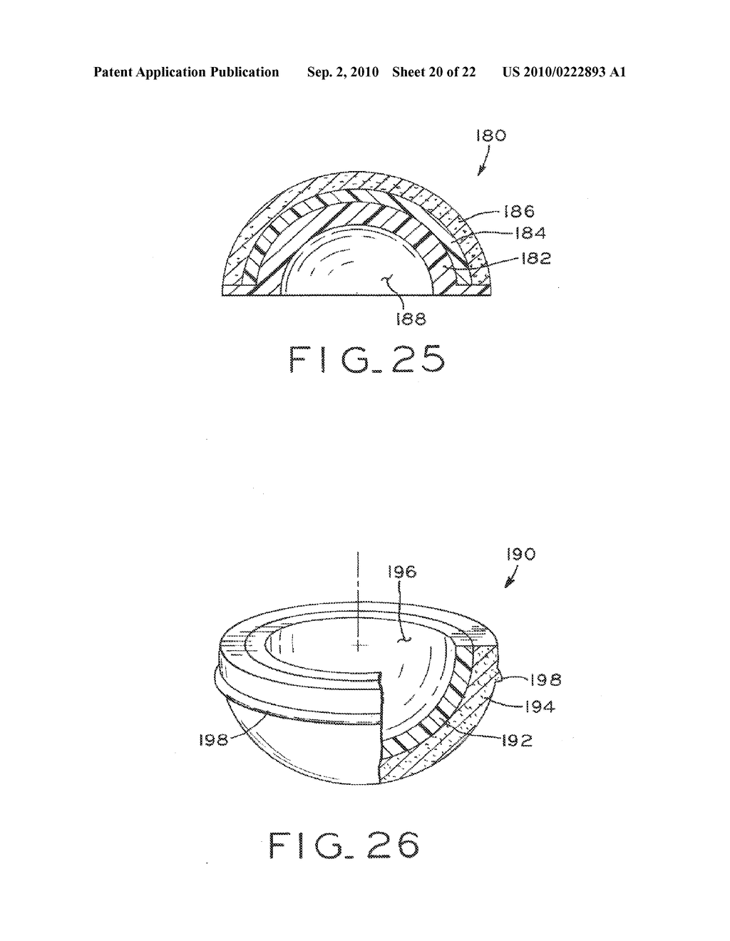 PROSTHETIC HIP IMPLANTS - diagram, schematic, and image 21