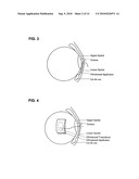 ULTRASOUND-ENHANCED INTRASCLERAL DELIVERY OF MACROMOLECULES diagram and image