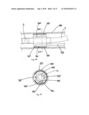 Catheter for conducting a procedure within a lumen, duct or organ of a living being diagram and image