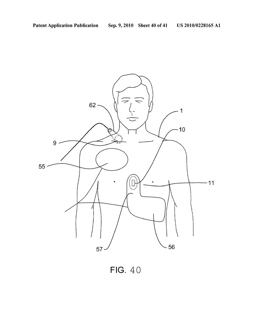 MEASUREMENT OF A COMPRESSION PARAMETER FOR CPR ON A SURFACE - diagram, schematic, and image 41