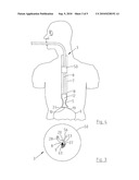  DEVICE AND A SYSTEM FOR USE IN A PROCEDURE FOR IMPROVING A SEALING FUNCTION OF A SPHINCTER AND A METHOD FOR IMPROVING THE SEALING FUNCTION OF A SPHINCTER diagram and image