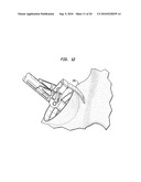 ACETABULAR SHELL REMOVAL INSTRUMENT diagram and image