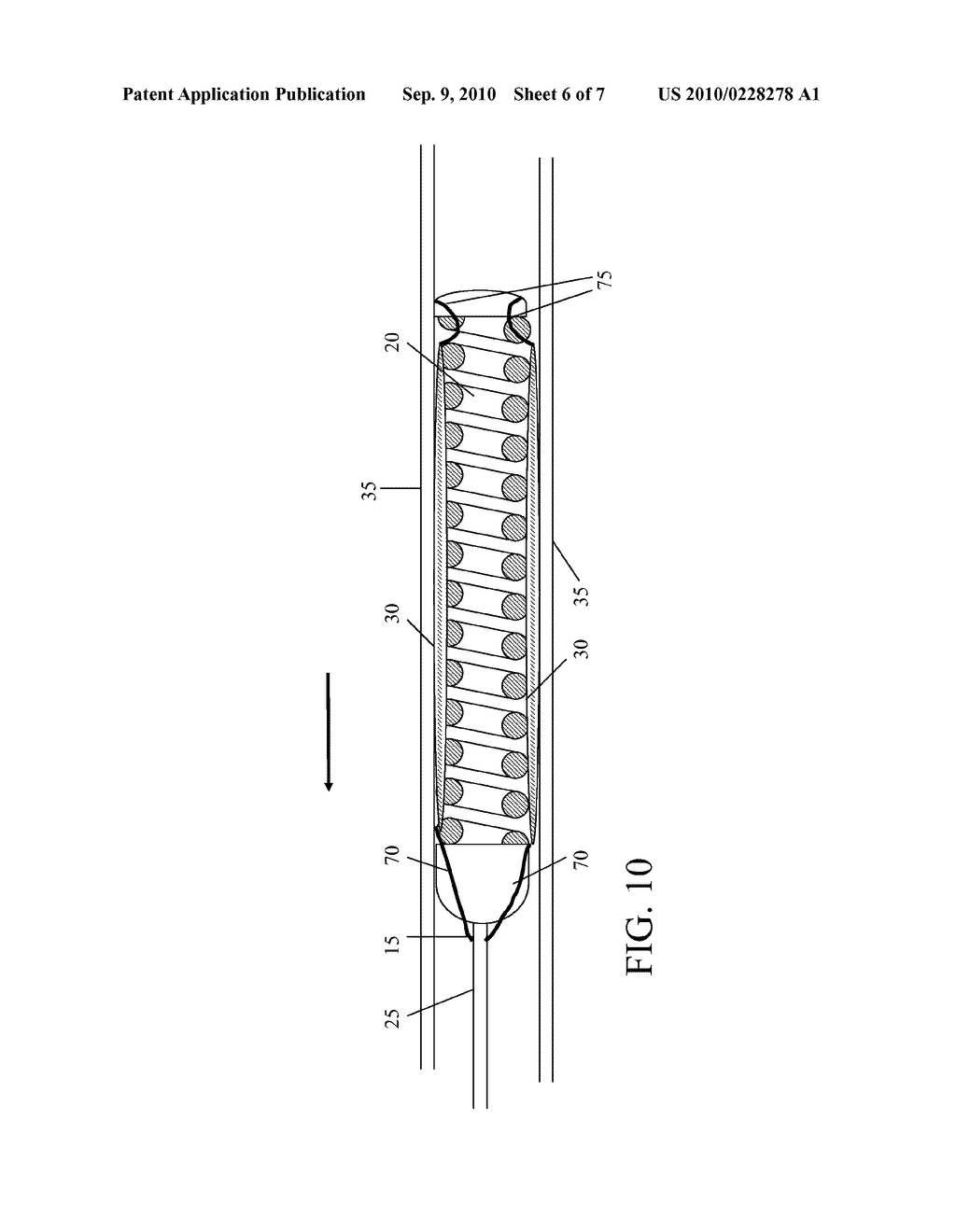 EXPANDING VASO-OCCLUSIVE DEVICE - diagram, schematic, and image 07