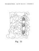 Single-Sided Dynamic Spine Plates diagram and image