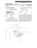 Method of Implanting a Subcutaneous Defibrillator diagram and image