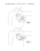 Method of Implanting a Subcutaneous Defibrillator diagram and image