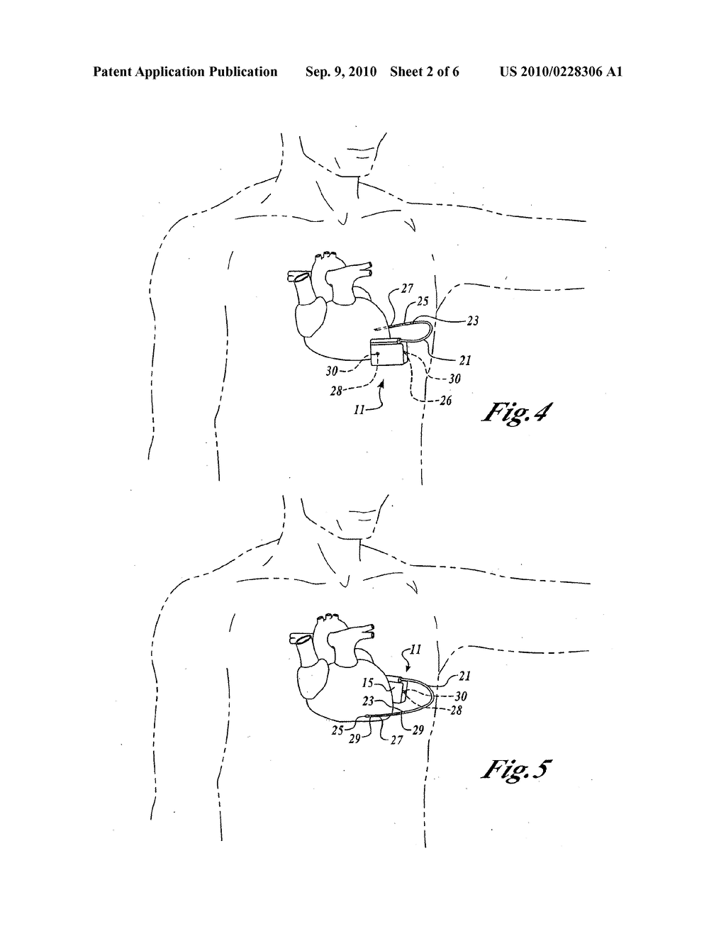 Method of Implanting a Subcutaneous Defibrillator - diagram, schematic, and image 03