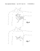 Method of Implanting a Subcutaneous Defibrillator diagram and image