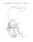 Responding to Partial Lead Failure in an Implantable Cardioverter Defibrillator diagram and image