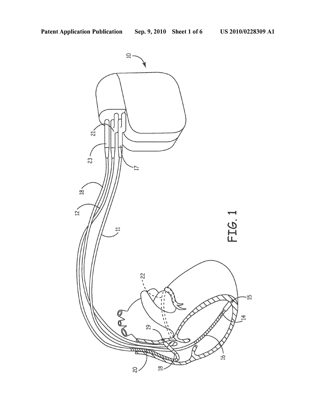 METHOD AND DEVICE FOR DELIVERING ANTI-TACHYCARDIA PACING THERAPY - diagram, schematic, and image 02