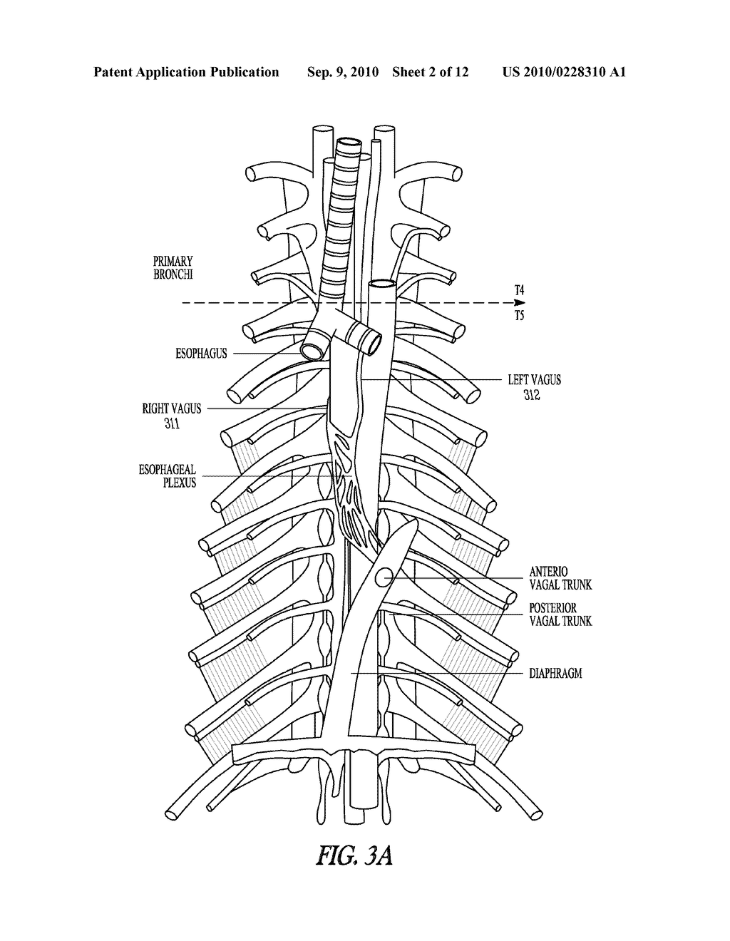 SYSTEMS AND METHODS FOR AUTONOMIC NERVE MODULATION - diagram, schematic, and image 03