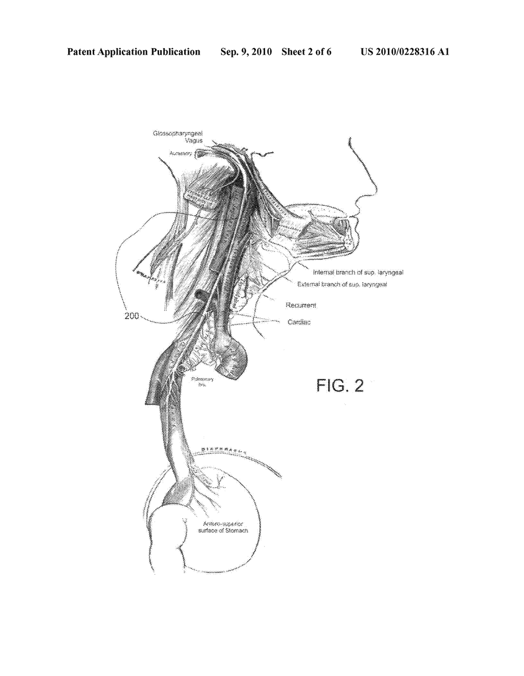 Methods and Apparatus for Treating Anaphylaxis Using Electrical Modulation - diagram, schematic, and image 03