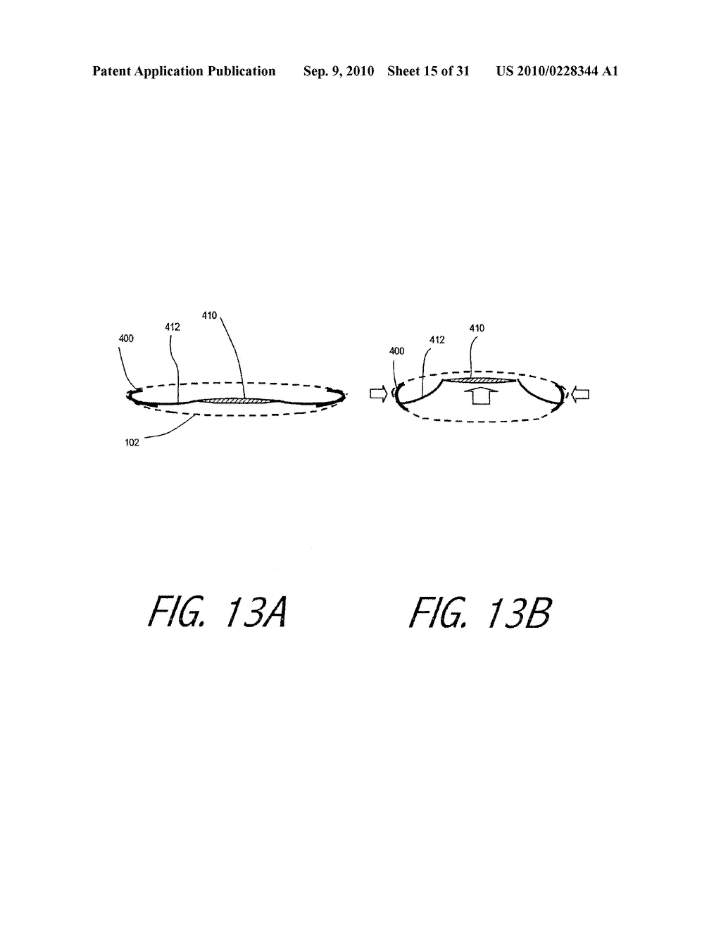 Accommodating Intraocular Lens - diagram, schematic, and image 16