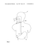 BULKING OF UPPER ESOPHAGEAL SPHINCTER FOR TREATMENT OF OBESITY diagram and image