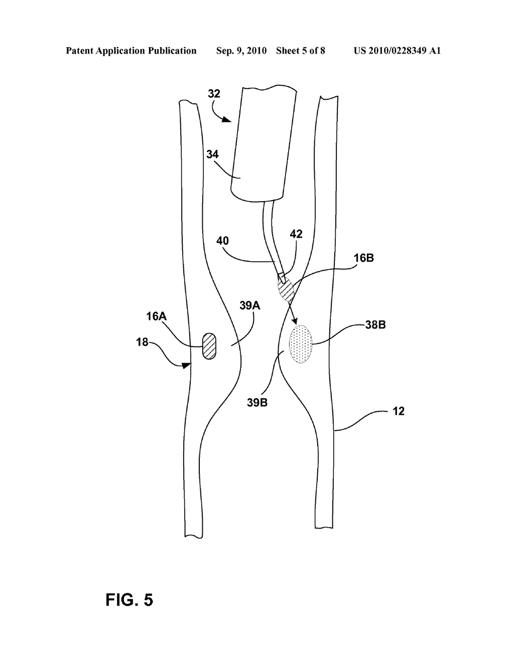 BULKING OF UPPER ESOPHAGEAL SPHINCTER FOR TREATMENT OF OBESITY - diagram, schematic, and image 06