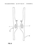 BULKING OF UPPER ESOPHAGEAL SPHINCTER FOR TREATMENT OF OBESITY diagram and image