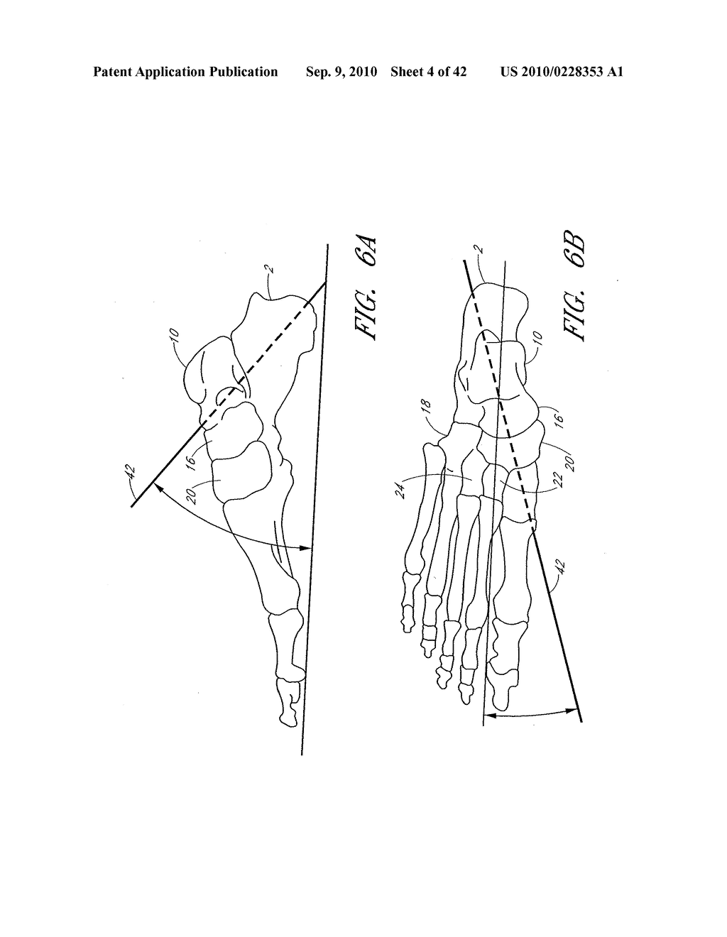 CATHETER DELIVERABLE FOOT IMPLANT AND METHOD OF DELIVERING THE SAME - diagram, schematic, and image 05