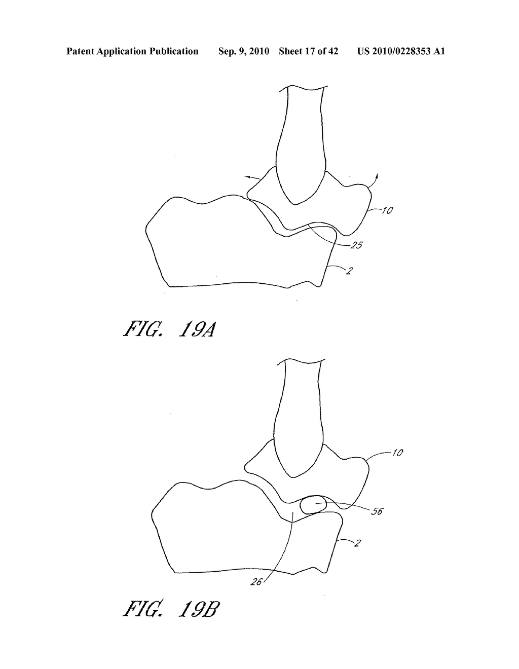 CATHETER DELIVERABLE FOOT IMPLANT AND METHOD OF DELIVERING THE SAME - diagram, schematic, and image 18