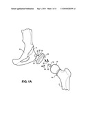 HIP SOCKET WITH ASSEMBLEABLE MALE BALL SHAPE HAVING INTEGRALLY FORMED LIGAMENT AND FEMALE RECEIVER AND INSTALLATION KIT diagram and image