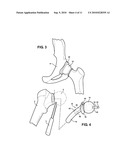 HIP SOCKET WITH ASSEMBLEABLE MALE BALL SHAPE HAVING INTEGRALLY FORMED LIGAMENT AND FEMALE RECEIVER AND INSTALLATION KIT diagram and image