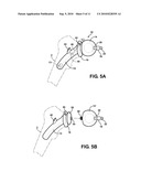 HIP SOCKET WITH ASSEMBLEABLE MALE BALL SHAPE HAVING INTEGRALLY FORMED LIGAMENT AND FEMALE RECEIVER AND INSTALLATION KIT diagram and image