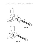 HIP SOCKET WITH ASSEMBLEABLE MALE BALL SHAPE HAVING INTEGRALLY FORMED LIGAMENT AND FEMALE RECEIVER AND INSTALLATION KIT diagram and image