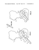 HIP SOCKET WITH ASSEMBLEABLE MALE BALL SHAPE HAVING INTEGRALLY FORMED LIGAMENT AND FEMALE RECEIVER AND INSTALLATION KIT diagram and image