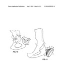 HIP SOCKET WITH ASSEMBLEABLE MALE BALL SHAPE HAVING INTEGRALLY FORMED LIGAMENT AND FEMALE RECEIVER AND INSTALLATION KIT diagram and image