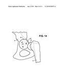 HIP SOCKET WITH ASSEMBLEABLE MALE BALL SHAPE HAVING INTEGRALLY FORMED LIGAMENT AND FEMALE RECEIVER AND INSTALLATION KIT diagram and image