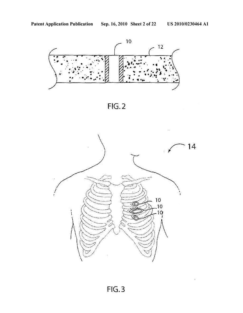 Driverless Surgical Stapler - diagram, schematic, and image 03