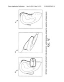 On-Site, Custom Fitted Hearing Equalizer diagram and image