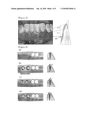 BUTTON FOR IMPLANT HEALING ABUTMENT AND IMPLANT HEALING ABUTMENT HAVING PRESSING PART diagram and image