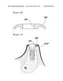 BUTTON FOR IMPLANT HEALING ABUTMENT AND IMPLANT HEALING ABUTMENT HAVING PRESSING PART diagram and image