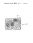 BIOMARKERS AND METHODS FOR DETERMINING SENSITIVITY TO VASCULAR ENDOTHELIAL GROWTH FACTOR RECEPTOR-2 MODULATORS diagram and image