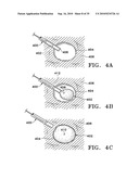 DEVICE AND METHOD FOR SAFE LOCATION AND MARKING OF A BIOPSY CAVITY diagram and image