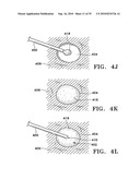 DEVICE AND METHOD FOR SAFE LOCATION AND MARKING OF A BIOPSY CAVITY diagram and image