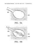 DEVICE AND METHOD FOR SAFE LOCATION AND MARKING OF A BIOPSY CAVITY diagram and image