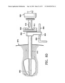 DEVICE AND METHOD FOR SAFE LOCATION AND MARKING OF A BIOPSY CAVITY diagram and image