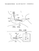 DEVICE AND METHOD FOR SAFE LOCATION AND MARKING OF A BIOPSY CAVITY diagram and image